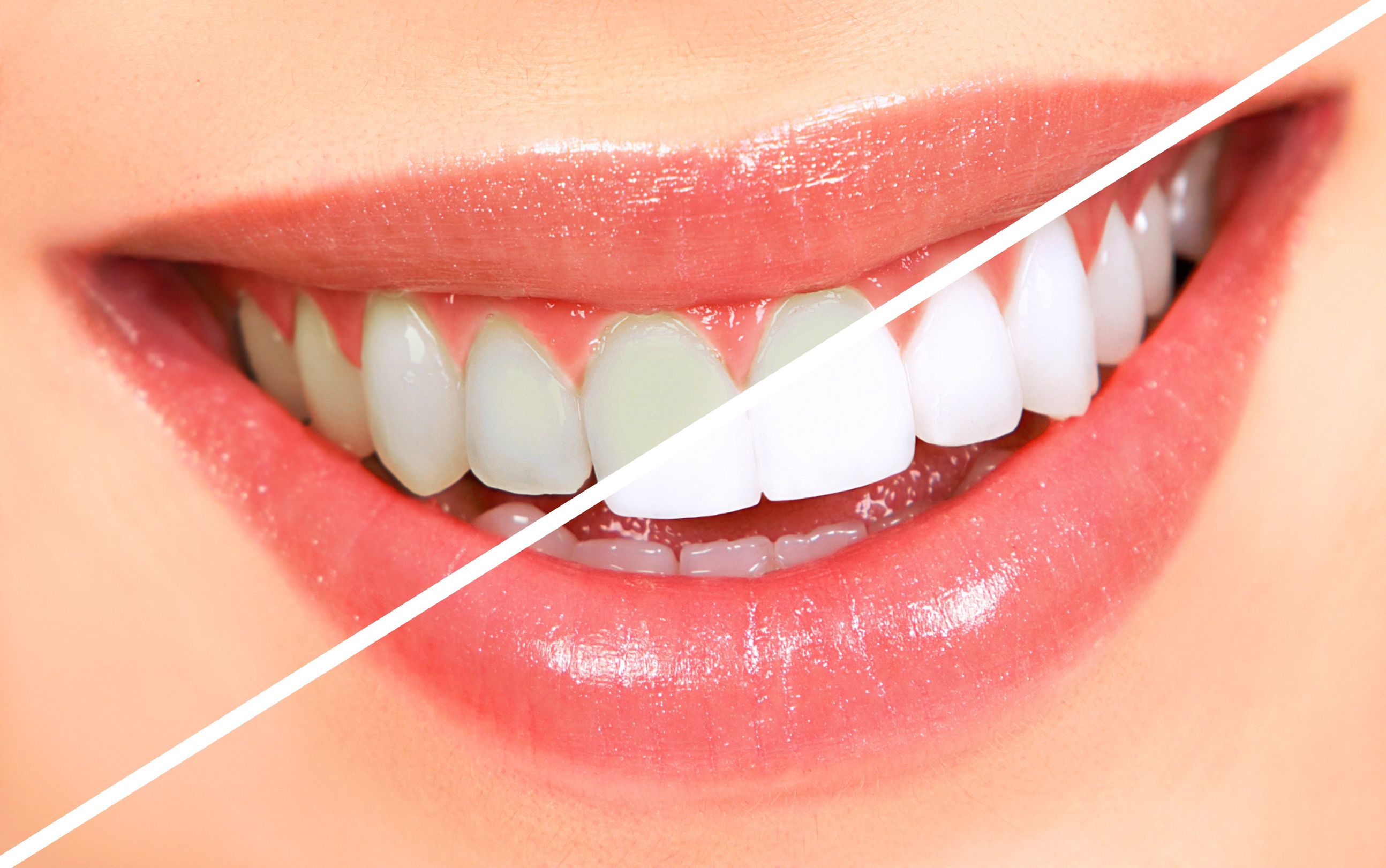 Understanding Root Canal Surgery in St George UT