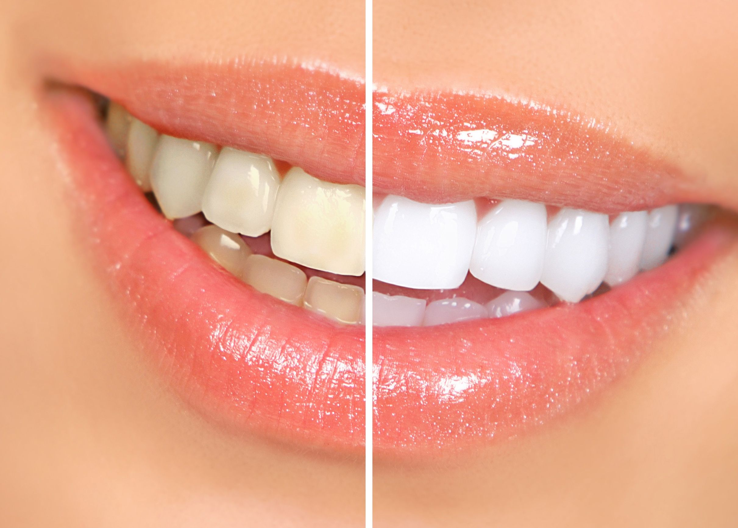Advantages of Using Dental Veneers in Salem OR