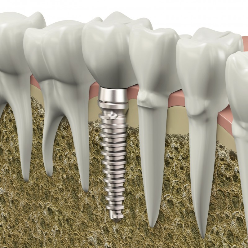 Would You Like to Learn More About Dental Implants in Queens NY?
